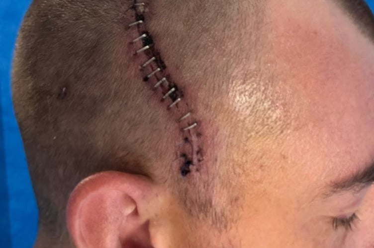 Sean's scars after brain Tumour op